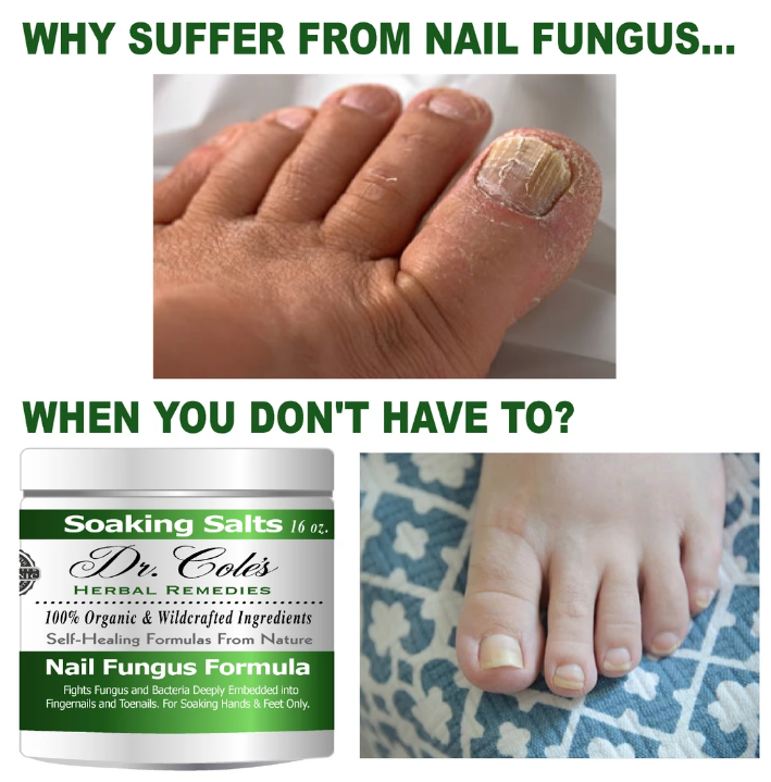 MOBU Herbals Nailed It! Nail Fungus Formula Dr. Cole's Herbal Remedy