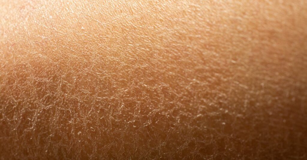 dry skin
